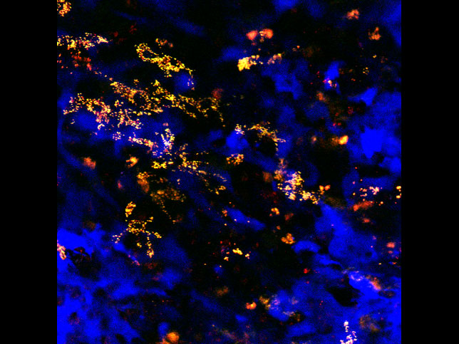 Dendritic cells within the tumor-immune microenvironment. We are interested understanding the contribution of dendritic cells and other antigen presenting cells to the local tumor-immune microenvironment.